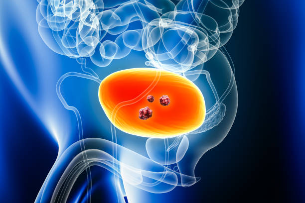 bladder cancer